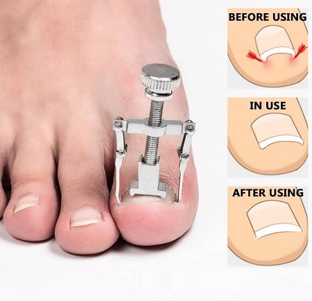 روش استفاده از دستگاه ارتودنسی ناخن پا